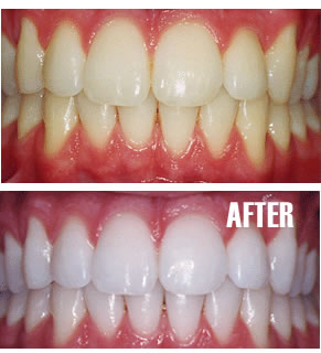 Dental bleaching